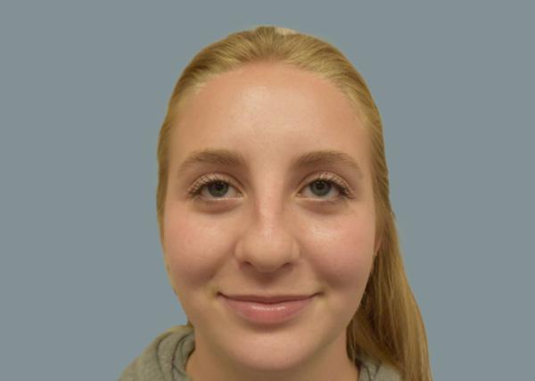 Rhinoplasty before at La Femme Plastic Surgery in Las Vegas, NV