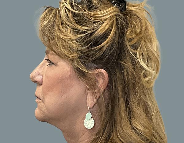 Facelift after at La Femme Plastic Surgery in Las Vegas, NV
