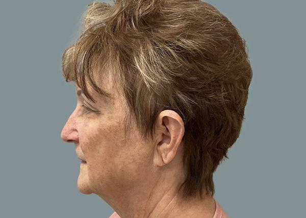 Brow Lift before at La Femme Plastic Surgery in Las Vegas, NV