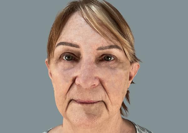 Blepharoplasty after at La Femme Plastic Surgery in Las Vegas, NV