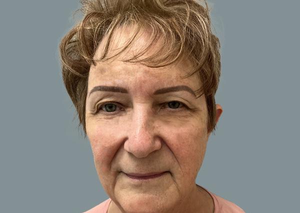 Blepharoplasty before at La Femme Plastic Surgery in Las Vegas, NV