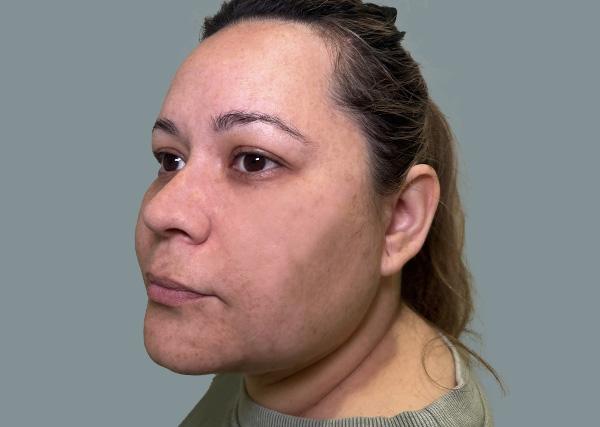 La Femme Plastic Surgery submental liposuction after — Las Vegas, NV