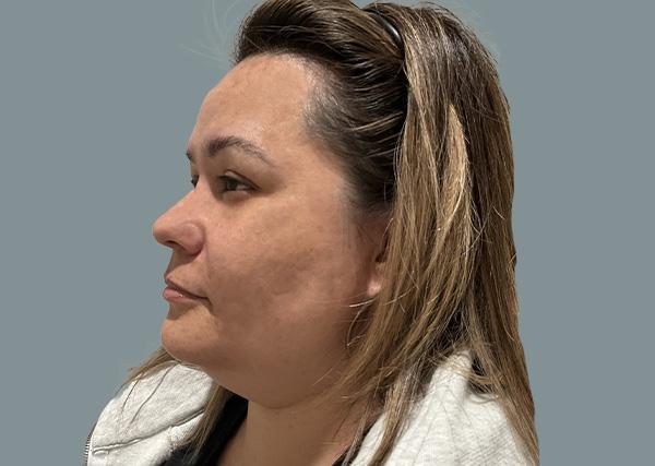Neck Liposuction before at La Femme Plastic Surgery in Las Vegas, NV