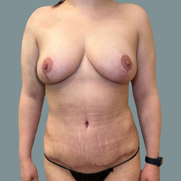 Mommy Makeover after at La Femme Plastic Surgery in Las Vegas, NV