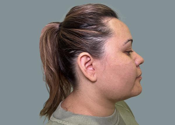 La Femme Plastic Surgery submental liposuction after — Las Vegas, NV