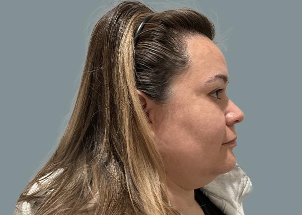 Neck Liposuction before at La Femme Plastic Surgery in Las Vegas, NV