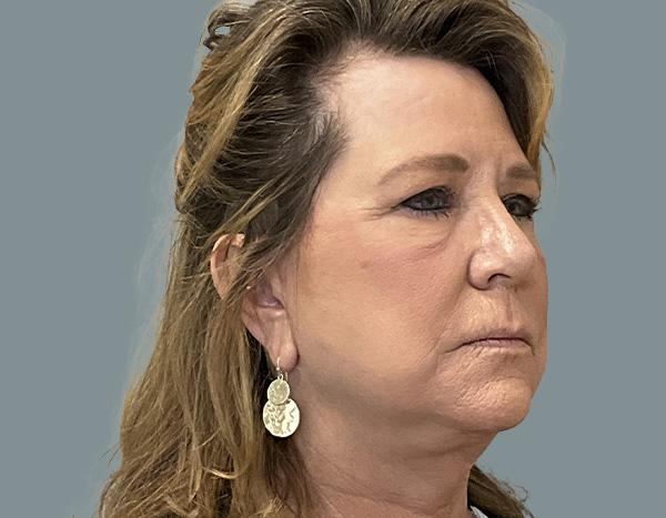 Facelift after at La Femme Plastic Surgery in Las Vegas, NV