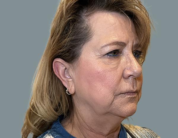 Facelift before at La Femme Plastic Surgery in Las Vegas, NV