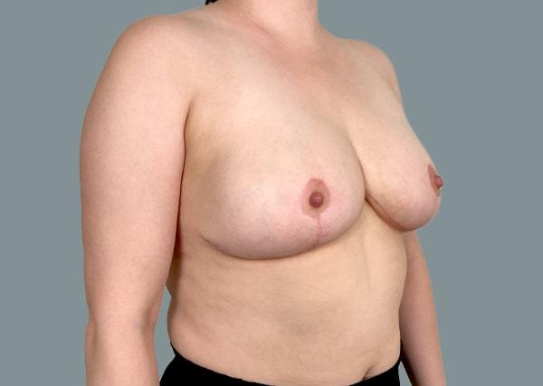 La Femme Plastic Surgery breast reduction after — Las Vegas, NV