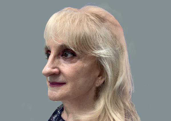 Neck Lift after at La Femme Plastic Surgery in Las Vegas, NV