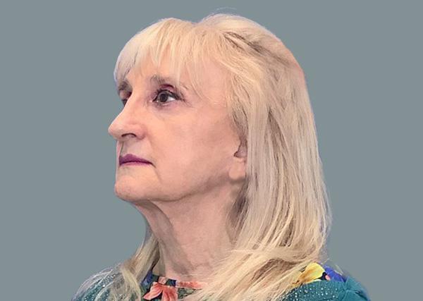 Neck Lift before at La Femme Plastic Surgery in Las Vegas, NV