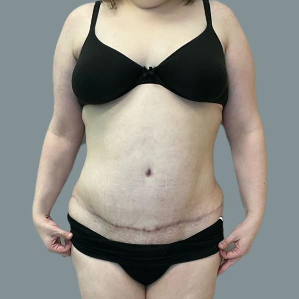 Tummy Tuck after at La Femme Plastic Surgery in Las Vegas, NV