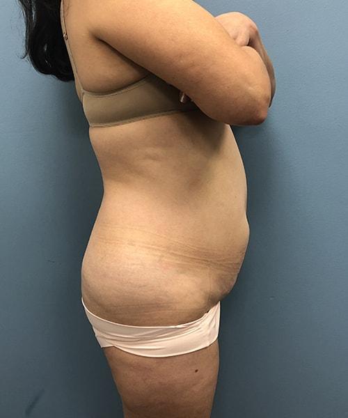 Mini Tummy Tuck before at Gables Plastic Surgery in Coral Gables, FL