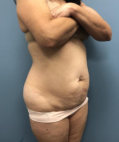Mini Tummy Tuck before at Gables Plastic Surgery in Coral Gables, FL