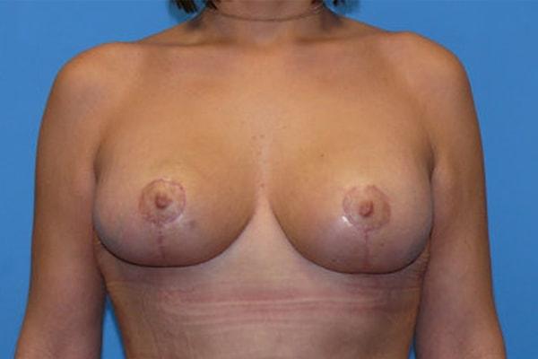 Breast Lift after at Gables Plastic Surgery in Coral Gables, FL