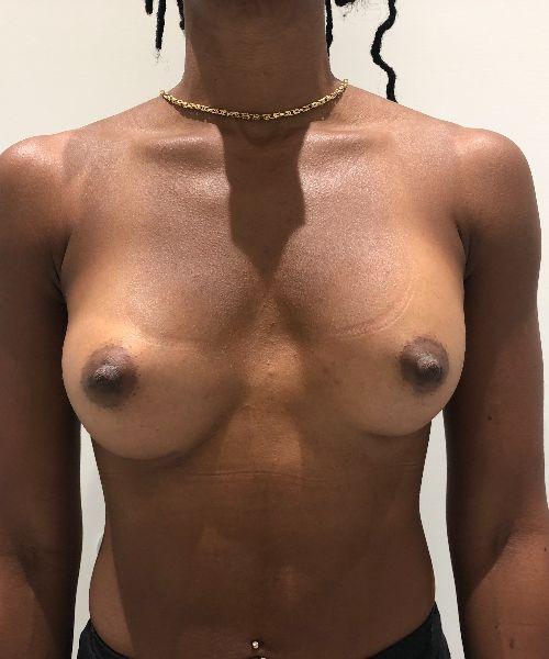 Breast Augmentation after at Gables Plastic Surgery in Coral Gables, FL