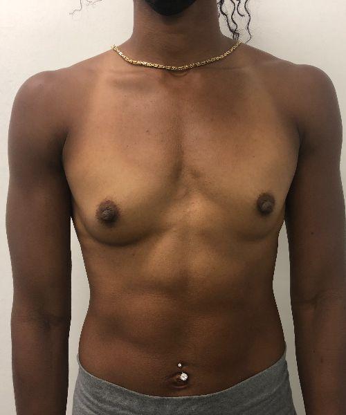 Breast Augmentation before at Gables Plastic Surgery in Coral Gables, FL