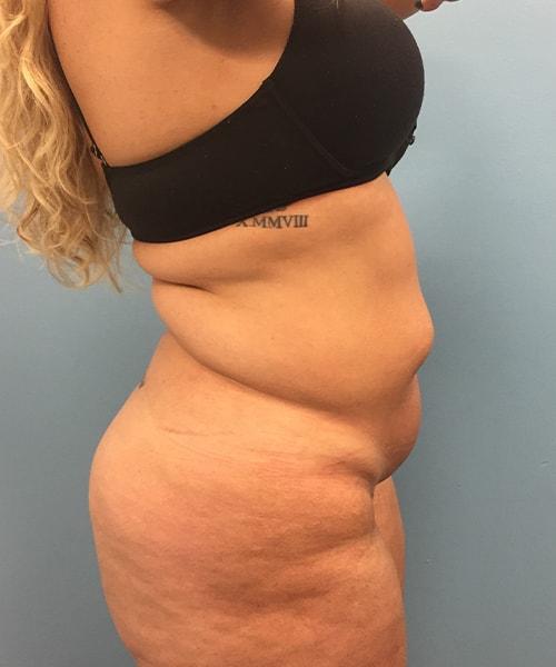 Mini Tummy Tuck before at Gables Plastic Surgery in Coral Gables, FL
