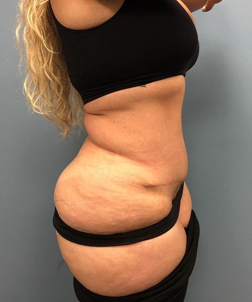 Mini Tummy Tuck after at Gables Plastic Surgery in Coral Gables, FL