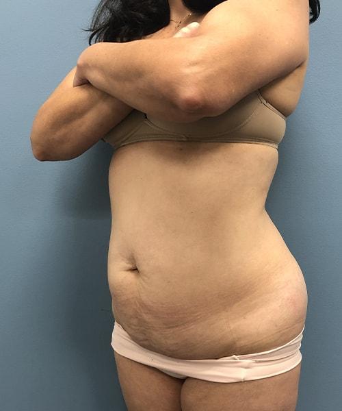 Mini Tummy Tuck before at Gables Plastic Surgery in Coral Gables, FL