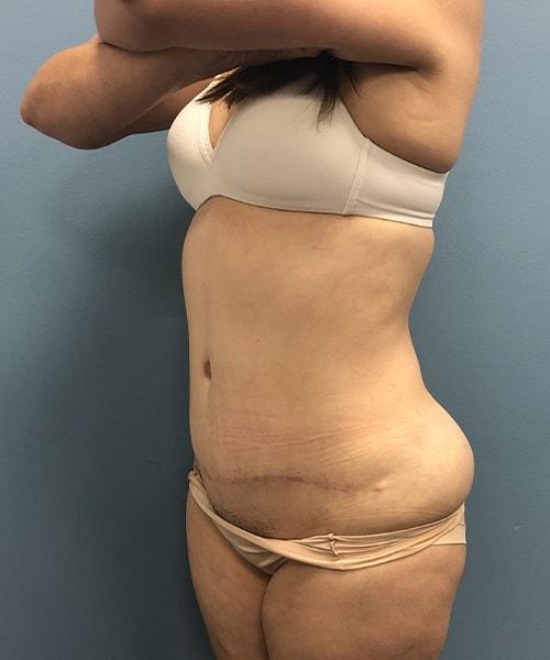 Mini Tummy Tuck after at Gables Plastic Surgery in Coral Gables, FL