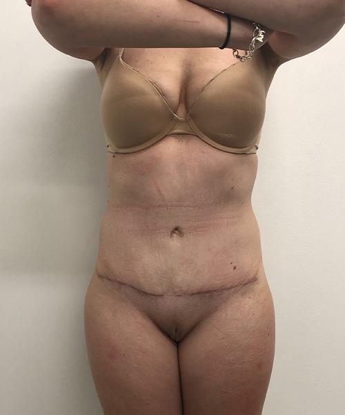 Tummy Tuck after at Gables Plastic Surgery in Coral Gables, FL