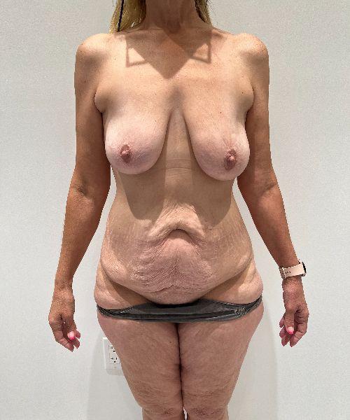Mommy Makeover before at Gables Plastic Surgery in Coral Gables, FL