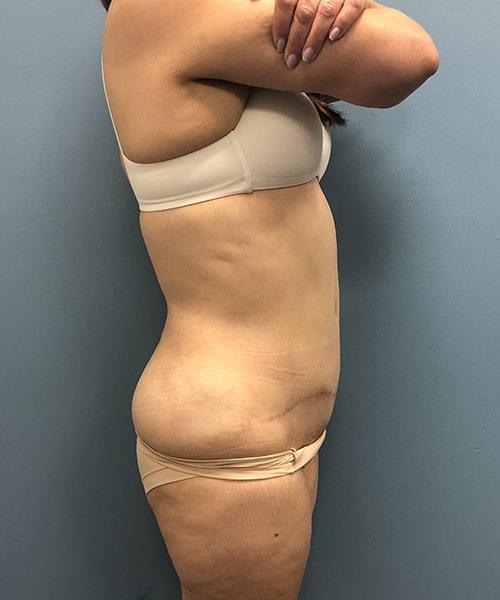 Mini Tummy Tuck after at Gables Plastic Surgery in Coral Gables, FL