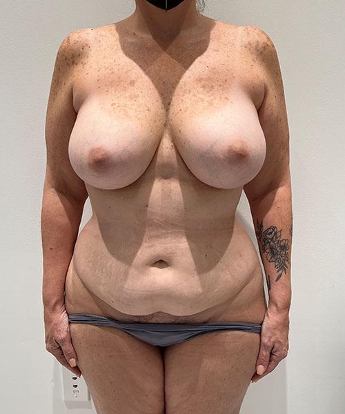 Mommy Makeover before at Gables Plastic Surgery in Coral Gables, FL