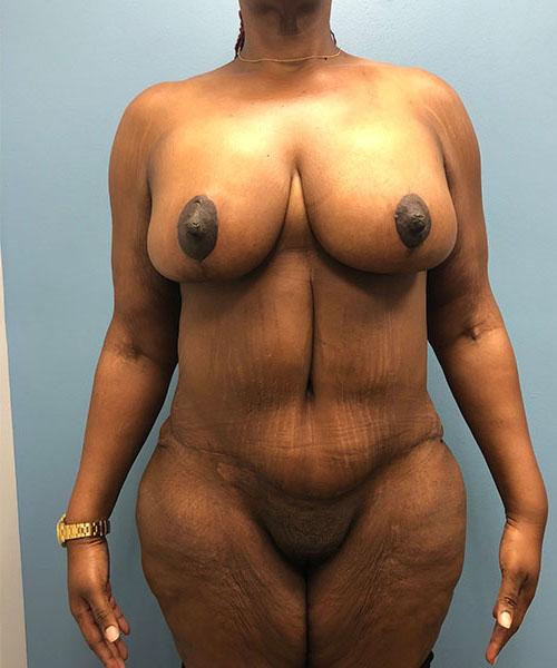 Gables Plastic Surgery mommy makeover after — Coral Gables, FL