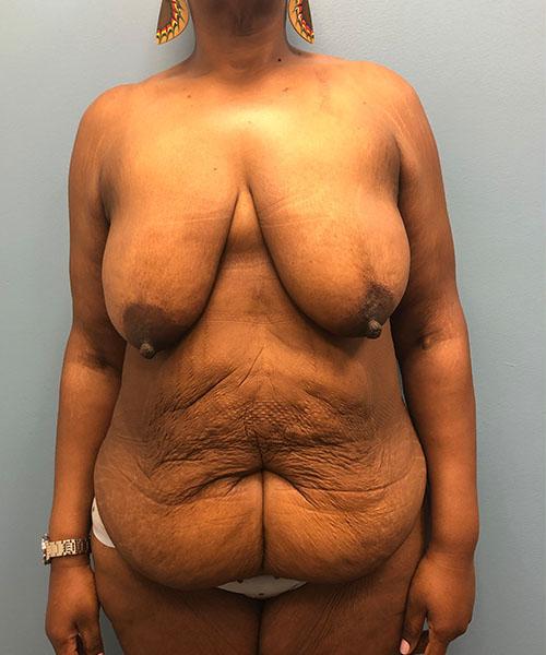 Mommy Makeover before at Gables Plastic Surgery in Coral Gables, FL