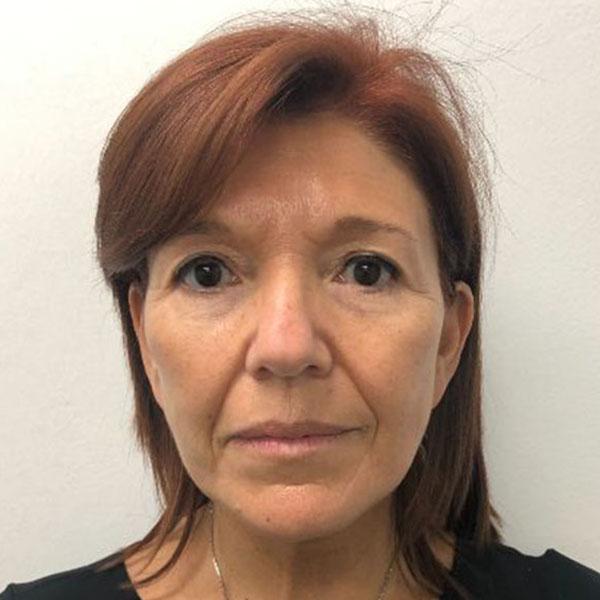 Facelift after at Gables Plastic Surgery in Coral Gables, FL
