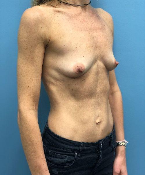 Breast Augmentation before at Gables Plastic Surgery in Coral Gables, FL