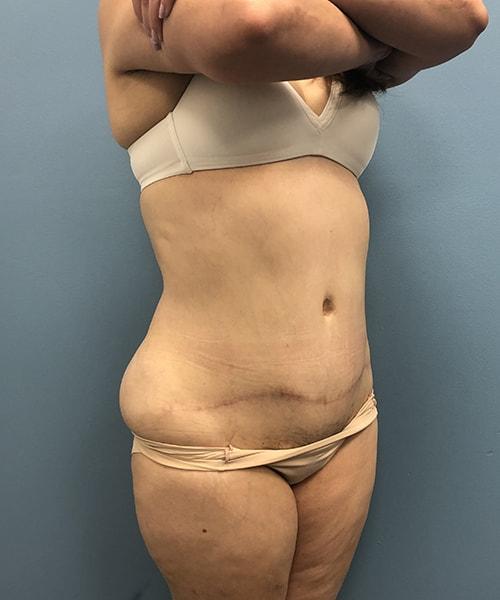 Mini Tummy Tuck after at Gables Plastic Surgery in Coral Gables, FL