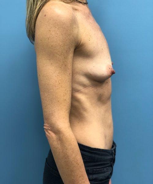Breast Augmentation before at Gables Plastic Surgery in Coral Gables, FL