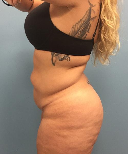 Mini Tummy Tuck before at Gables Plastic Surgery in Coral Gables, FL