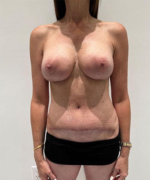Gables Plastic Surgery mommy makeover after — Coral Gables, FL