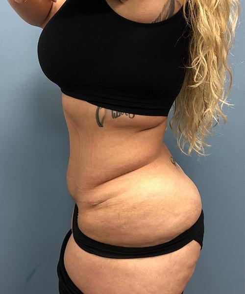 Gables Plastic Surgery tummy tuck after — Coral Gables, FL