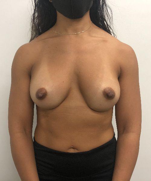Breast Augmentation after at Gables Plastic Surgery in Coral Gables, FL