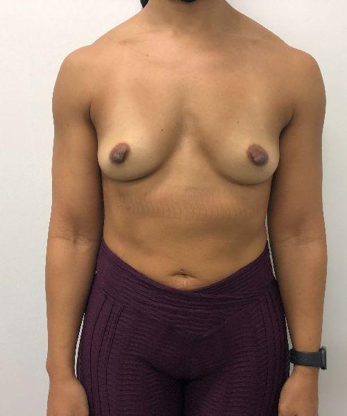 Breast Augmentation before at Gables Plastic Surgery in Coral Gables, FL