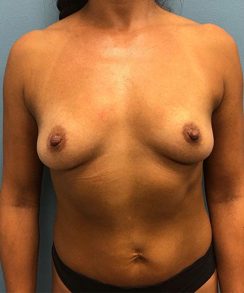 Breast Augmentation before at Gables Plastic Surgery in Coral Gables, FL
