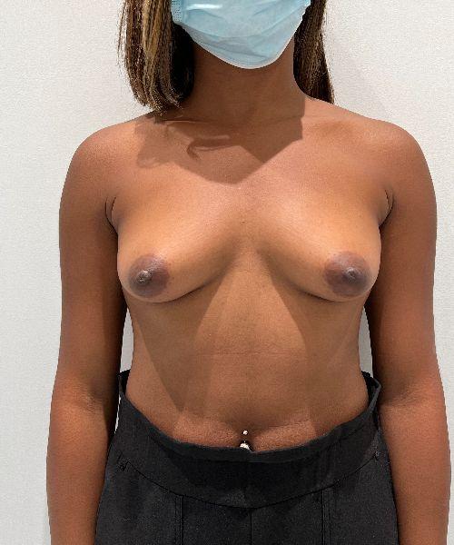 Breast Augmentation before at Gables Plastic Surgery in Coral Gables, FL