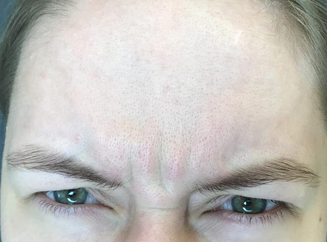 Botox before at Juno Aesthetics (Julia Giyaur, MD) in Brooklyn, NY