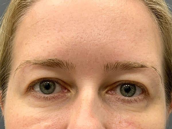 Botox after at Juno Aesthetics (Julia Giyaur, MD) in Brooklyn, NY
