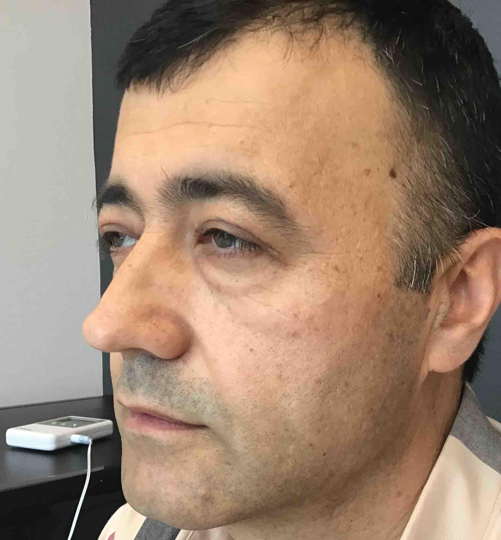 Juno Aesthetics (Julia Giyaur, MD) eyelid lift after — Brooklyn, NY