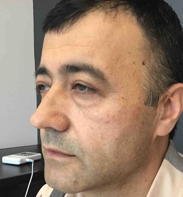 Blepharoplasty after at Juno Aesthetics (Julia Giyaur, MD) in Brooklyn, NY
