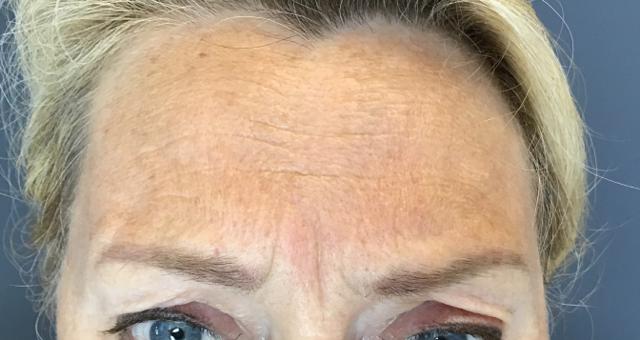 Botox before at Juno Aesthetics (Julia Giyaur, MD) in Brooklyn, NY