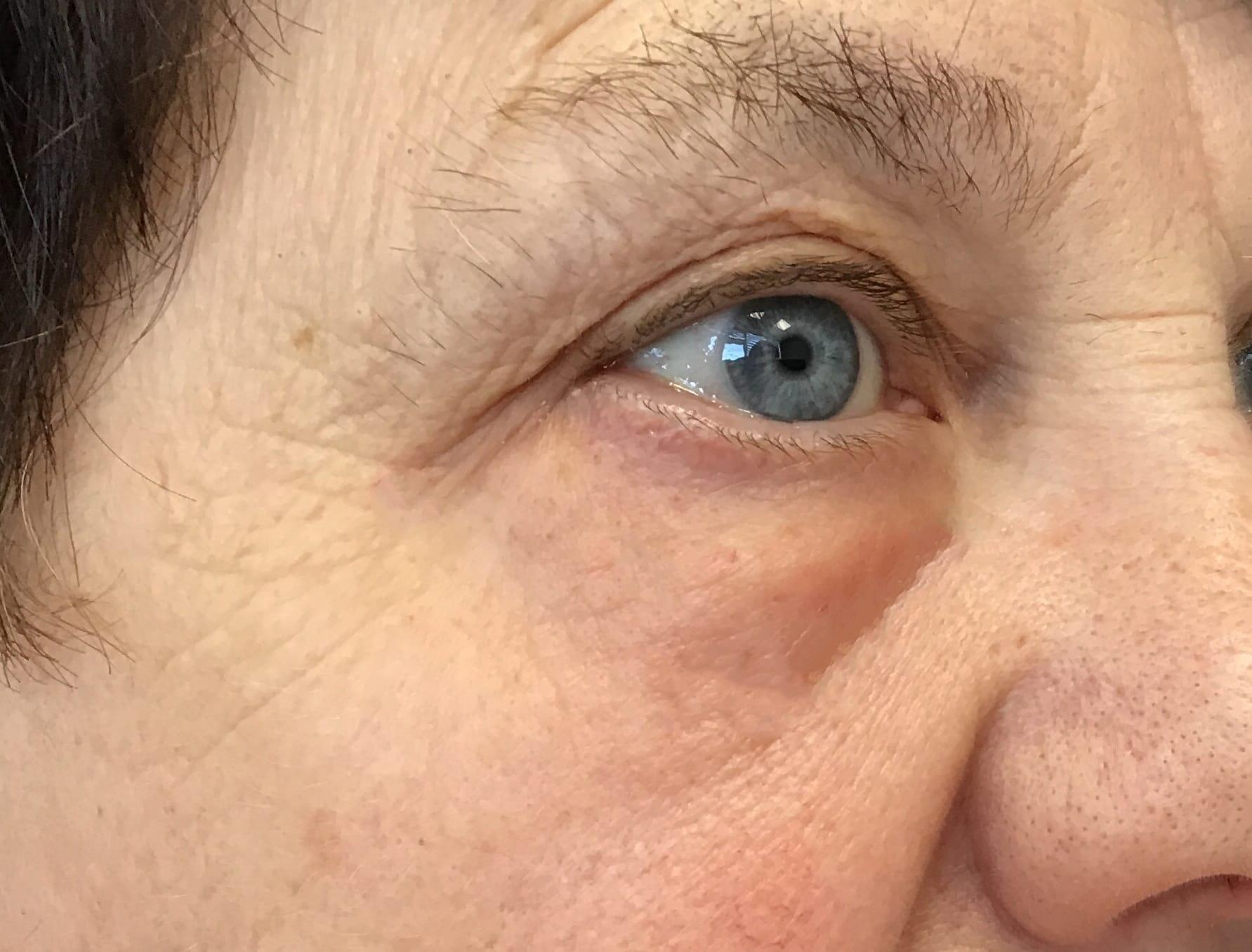 Juno Aesthetics (Julia Giyaur, MD) under-eye filler after — Brooklyn, NY