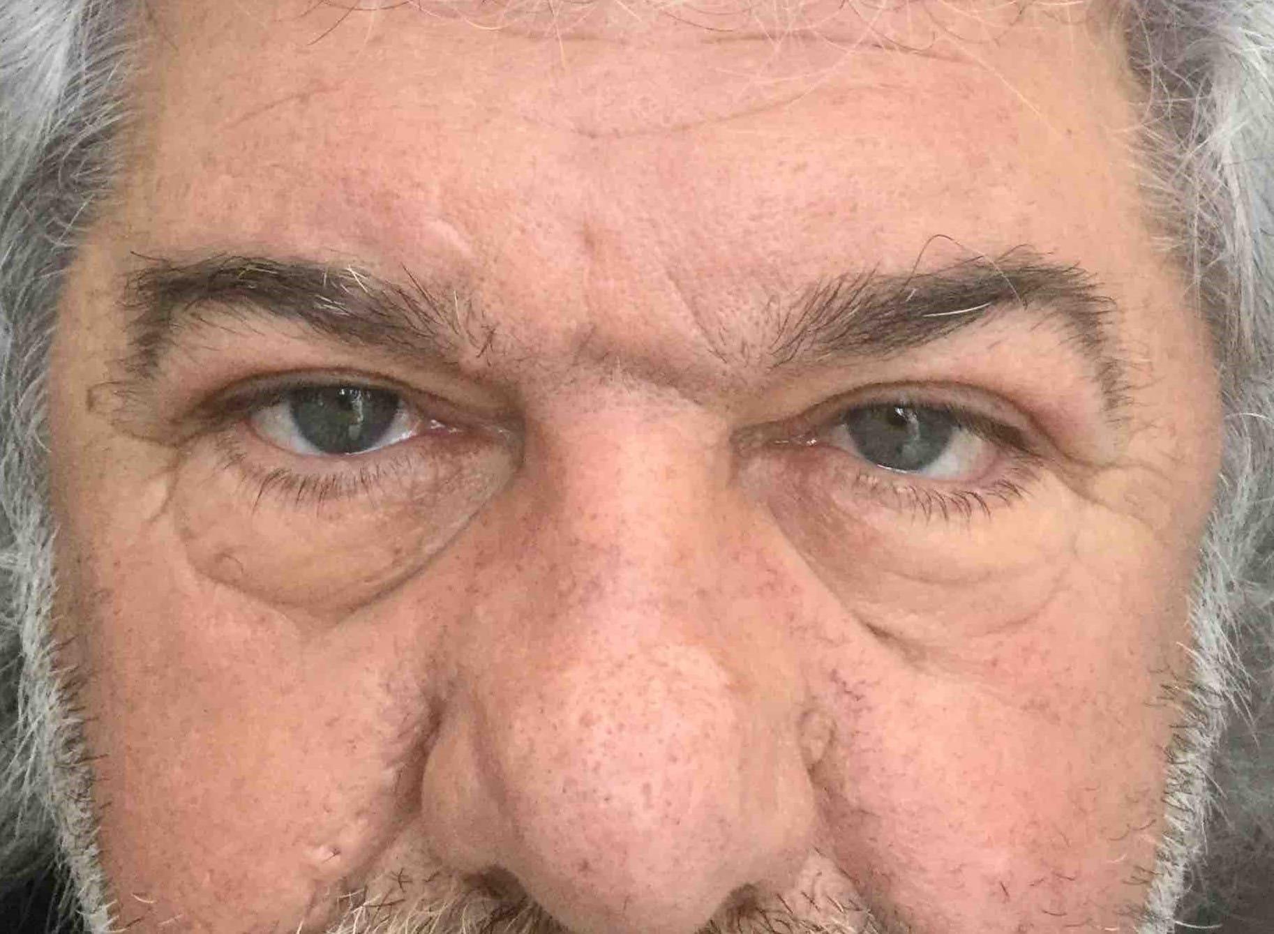 Juno Aesthetics (Julia Giyaur, MD) eyelid lift after — Brooklyn, NY