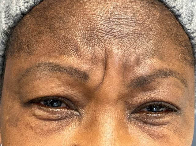Botox before at Juno Aesthetics (Julia Giyaur, MD) in Brooklyn, NY